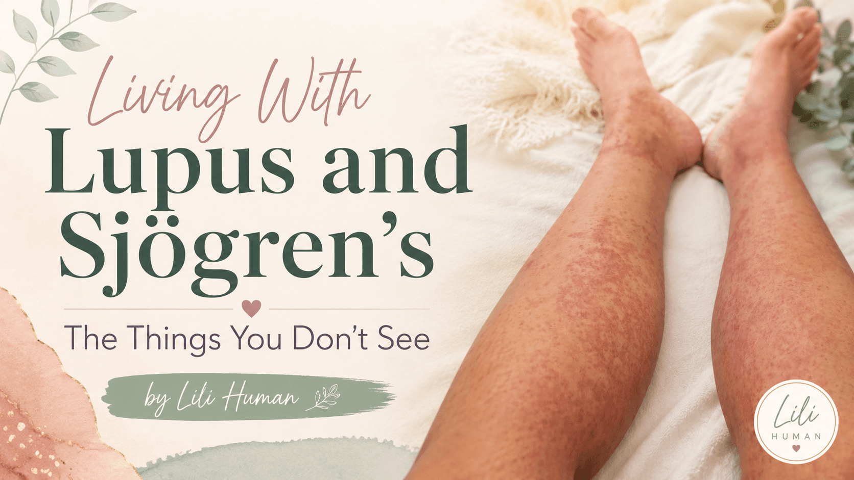 Living With Lupus and Sjögren's: The Things You Don't See